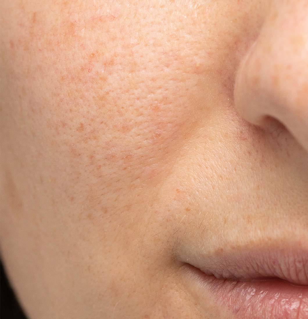 Rosacea Laser Treatment Dallas After