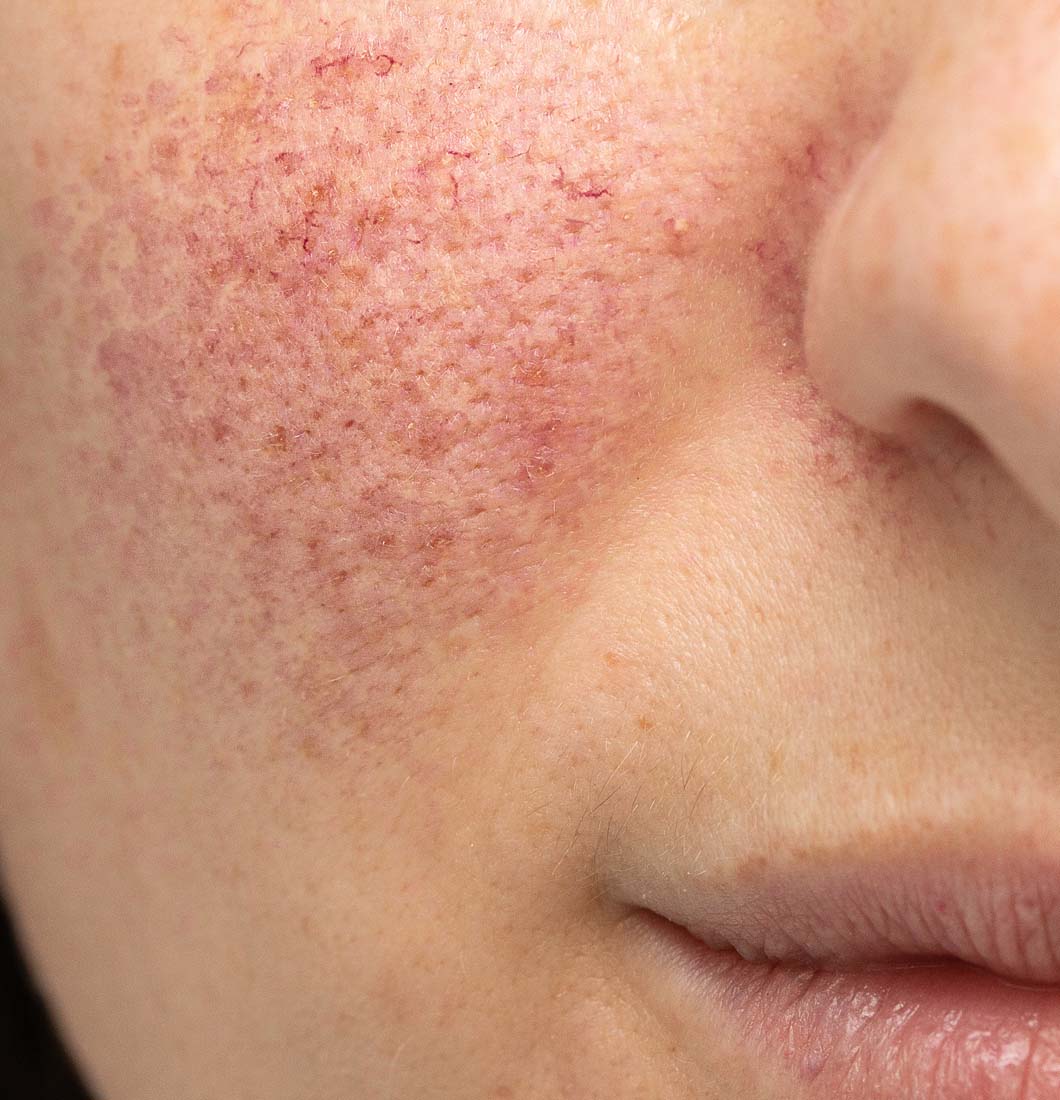 Rosacea Laser Treatment Dallas Before