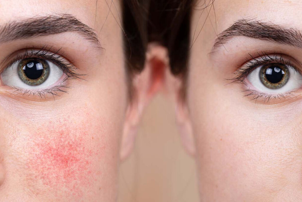 Rosacea Treatment Dallas