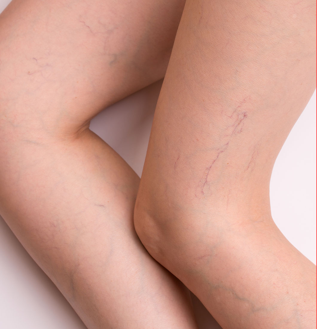 Spider Vein Therapy Plano