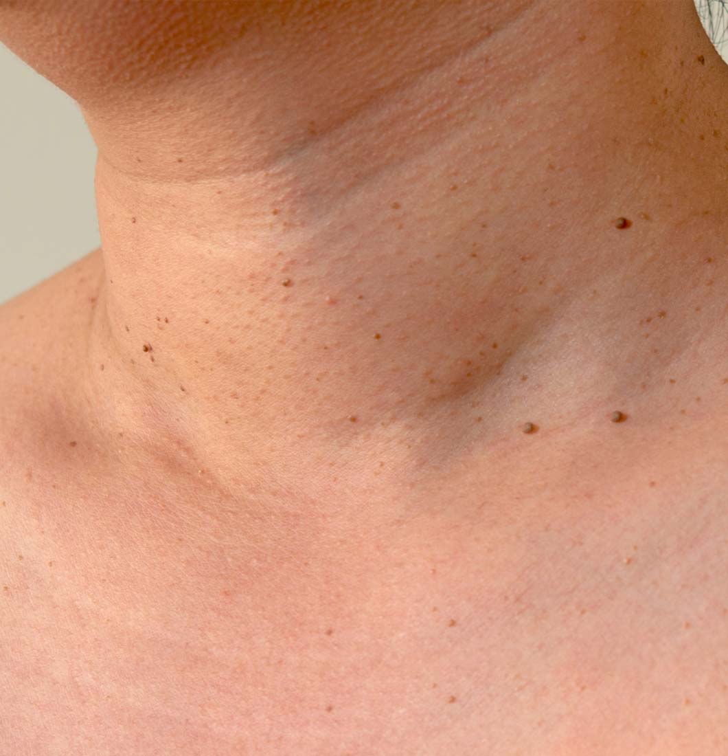 What causes skin tags?