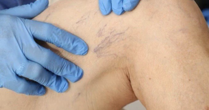 Treatment of spider veins