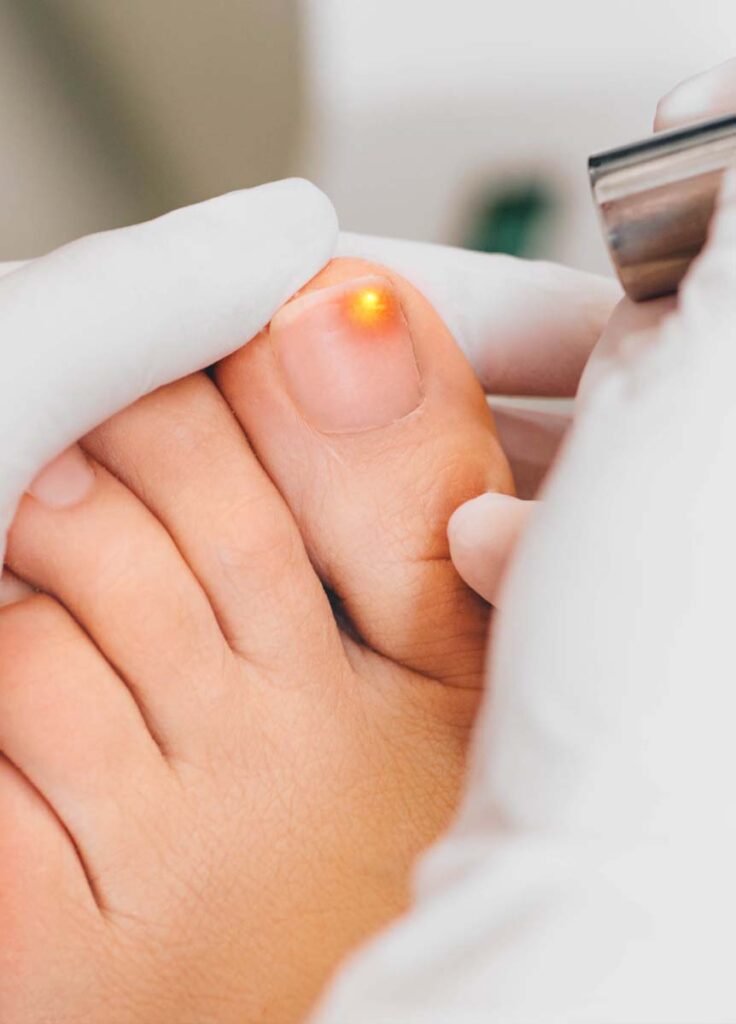 Nail Fungus vs. Other Nail Conditions