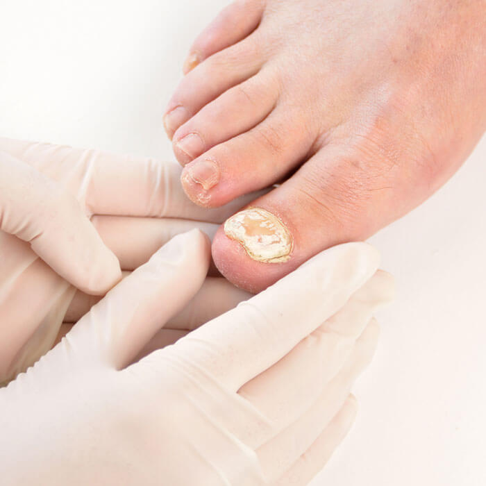 Preventing nail fungus