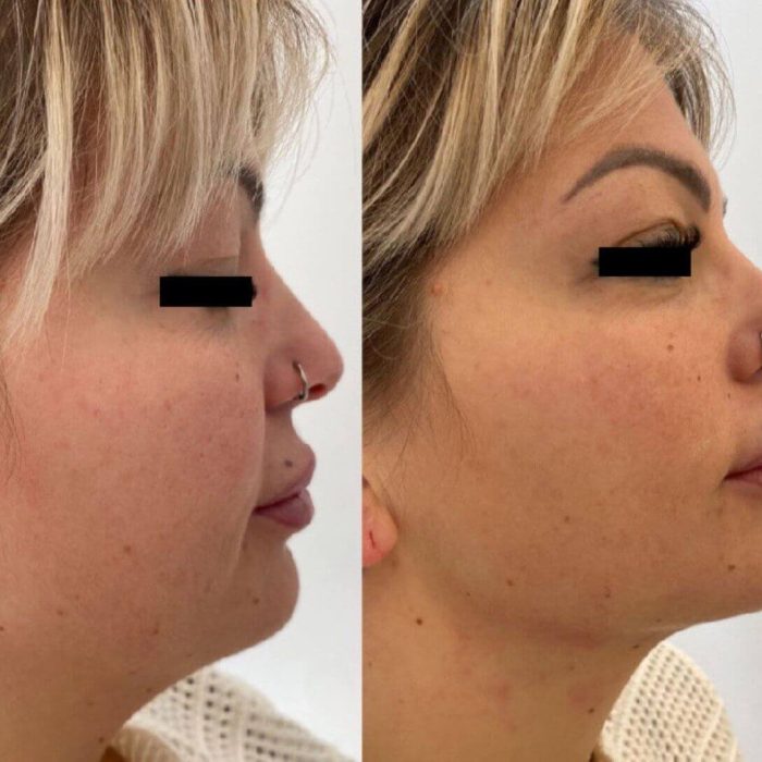 HIFU vs. surgical facelift comparison.