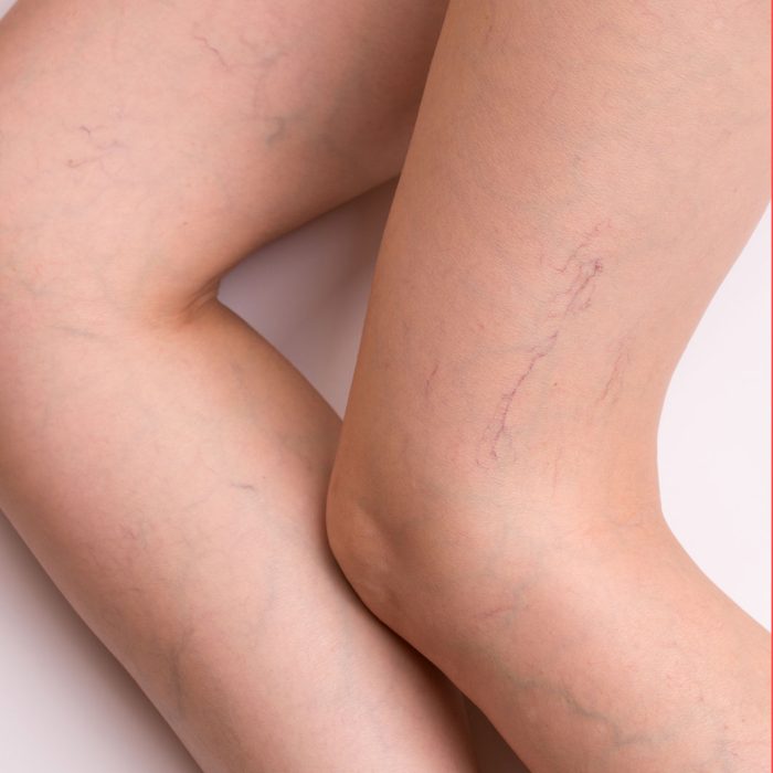 Spider Veins in Pregnancy